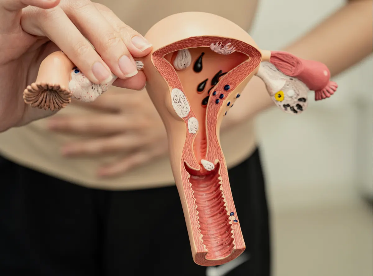 Endometriosis