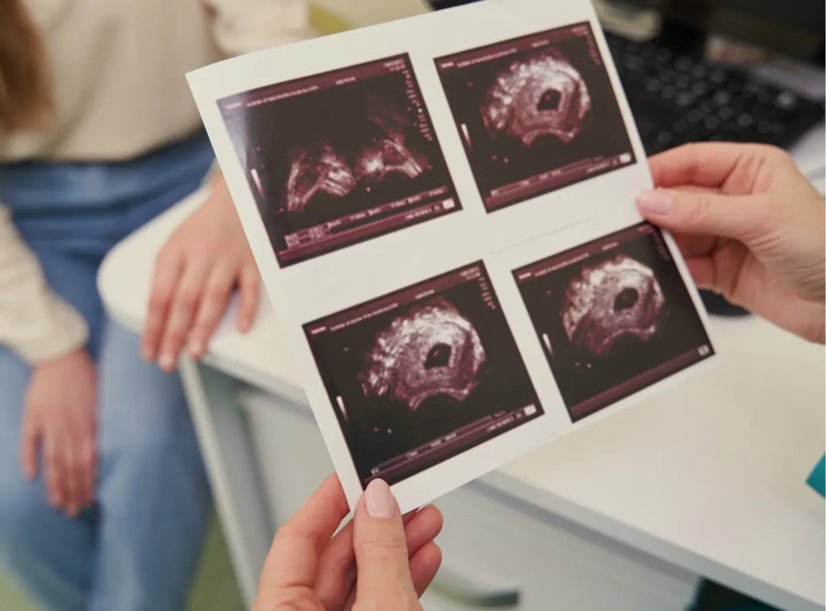 Fibroids
