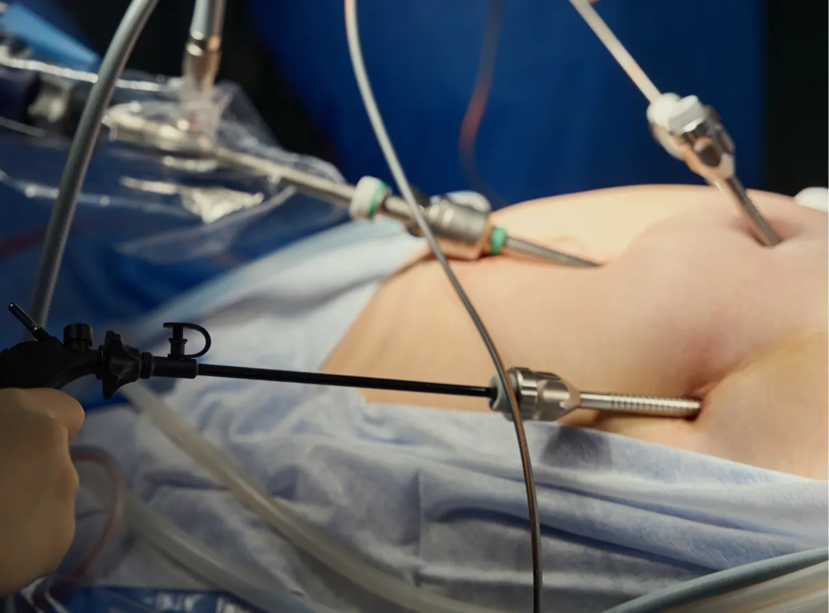 Laparoscopic Removal of Ovaries (BSO)