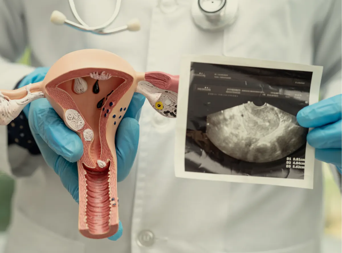 Ovarian Cysts